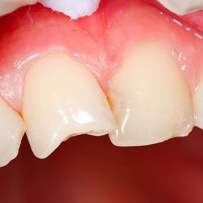 Dental Bonding Services for damaged teeth