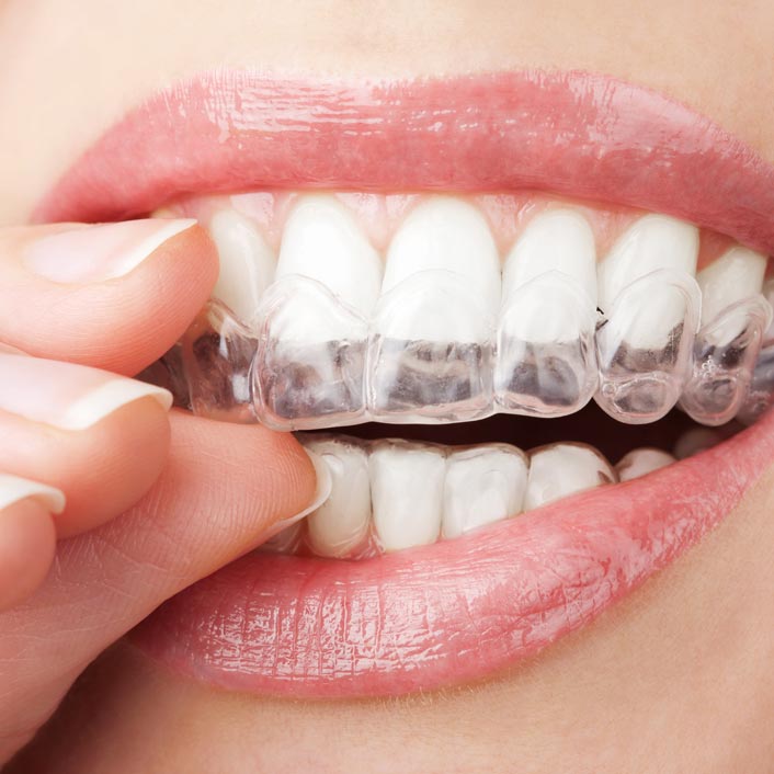 Clear Aligners