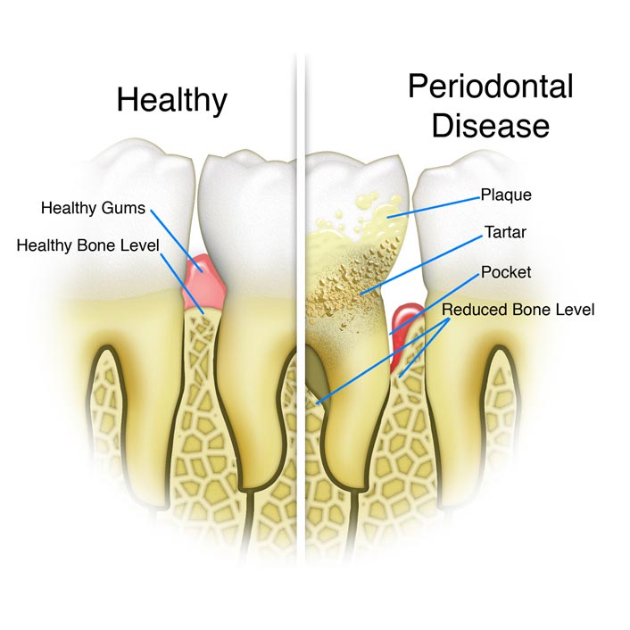 Periodontal Gum Treatments